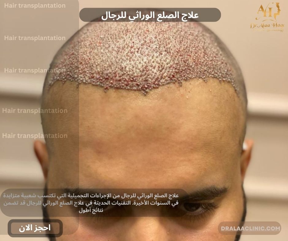 علاج الصلع الوراثي للرجال