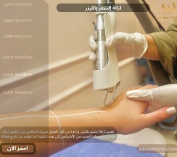 ازالة الشعر بالليزر