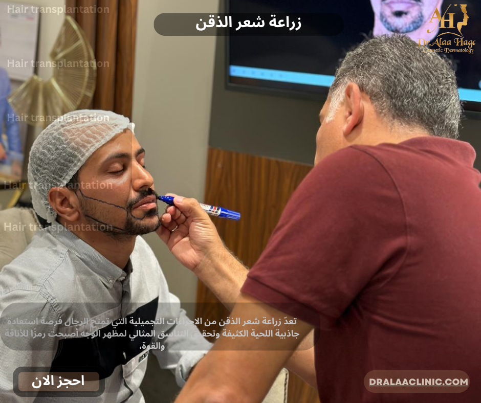 زراعة شعر الذقن