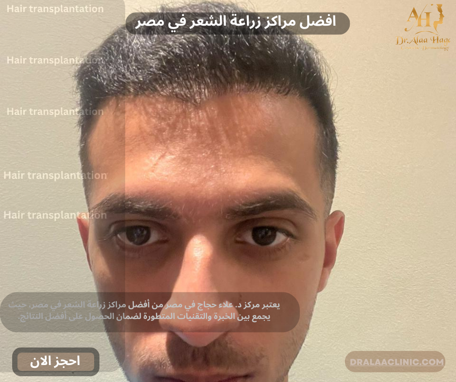 افضل مراكز زراعة الشعر في مصر