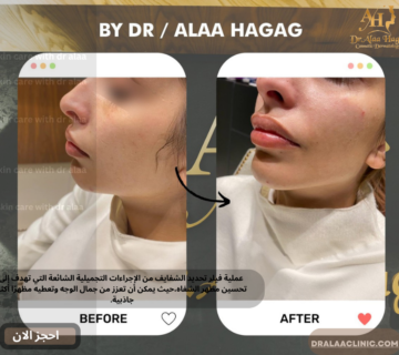 فيلر تحديد الشفايف