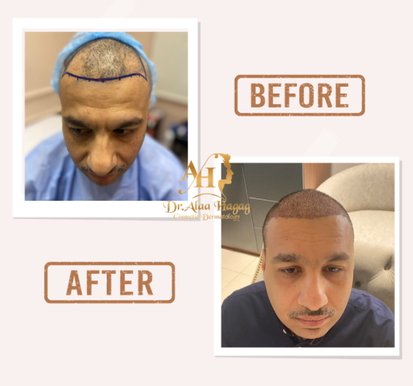 زراعه الشعر