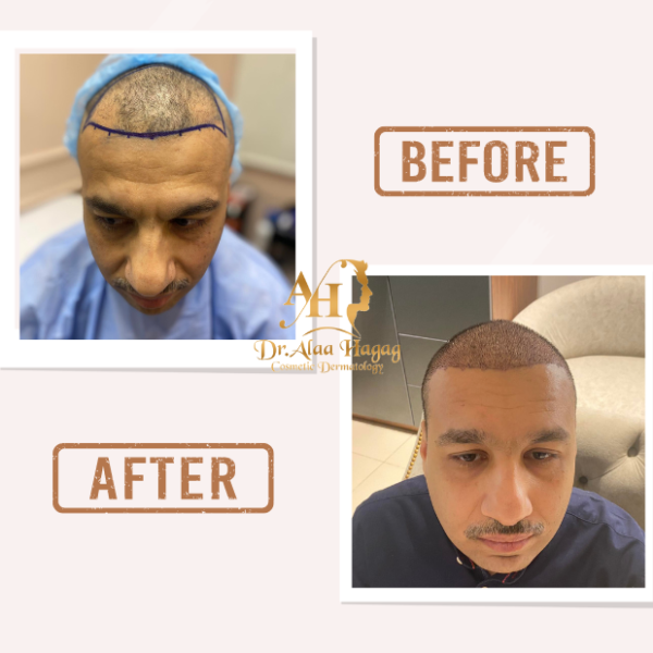 زراعه الشعر