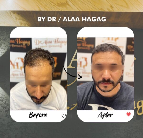 زراعة شعر التفلة