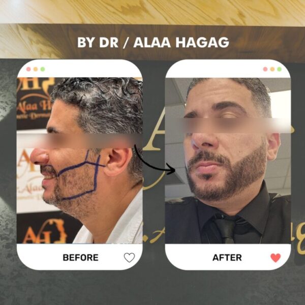 زراعة الذقن في الرياض