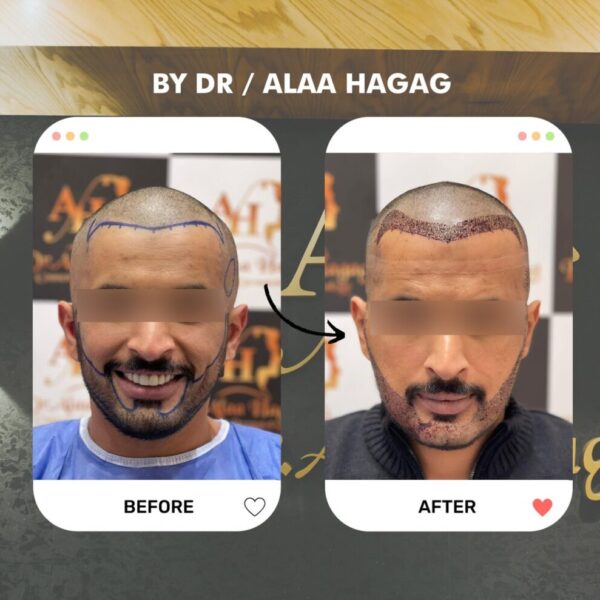 زراعة شعر التفلة