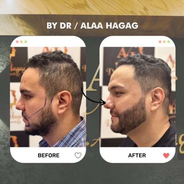 زراعة الذقن في الرياض