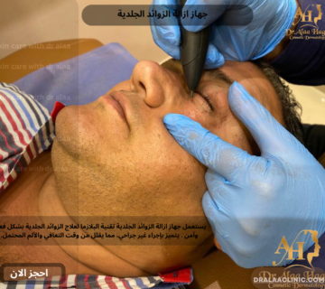 جهاز ازالة الزوائد الجلدية