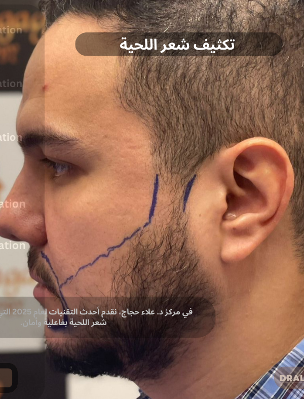 تكثيف شعر اللحية