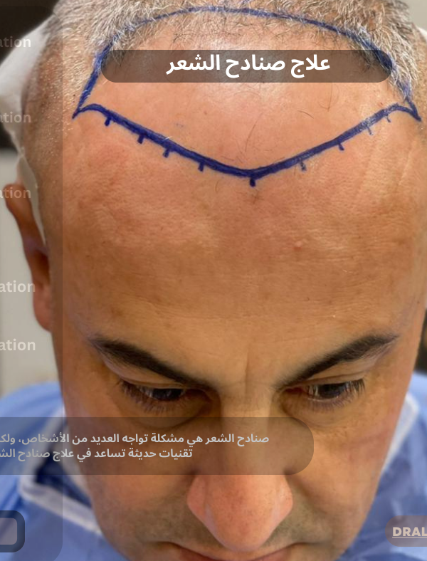 علاج صنادح الشعر