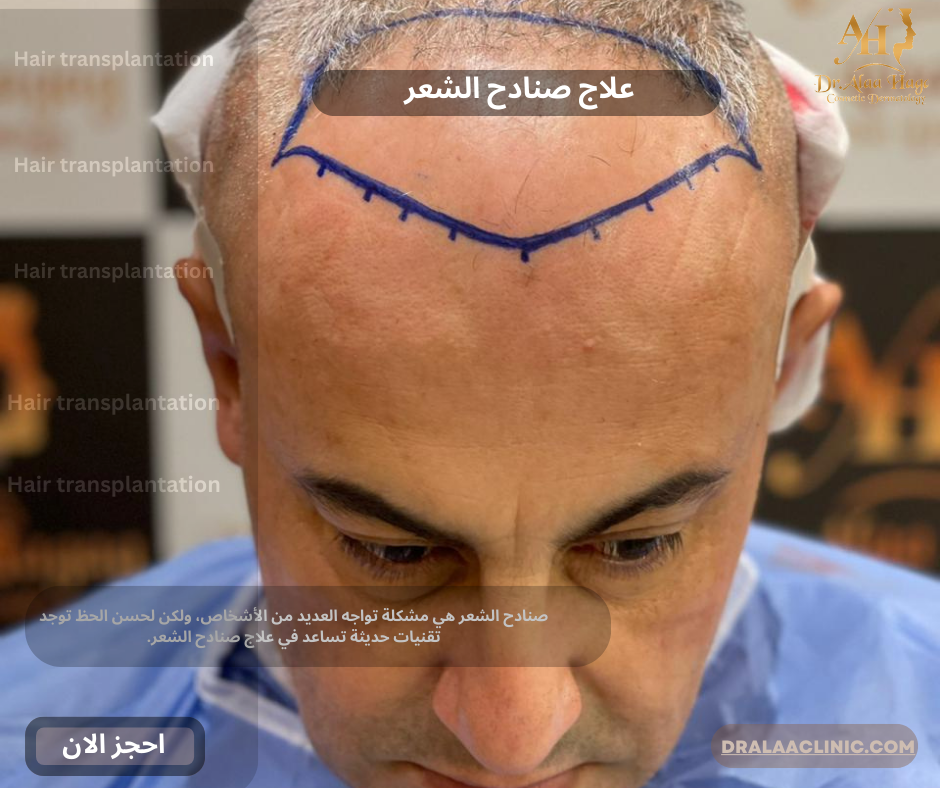 علاج صنادح الشعر