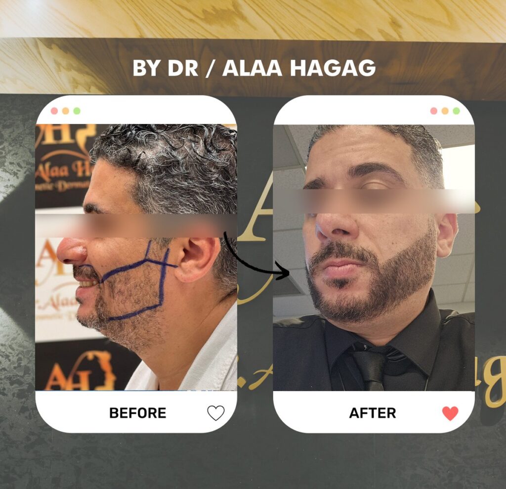 تكثيف شعر اللحية
