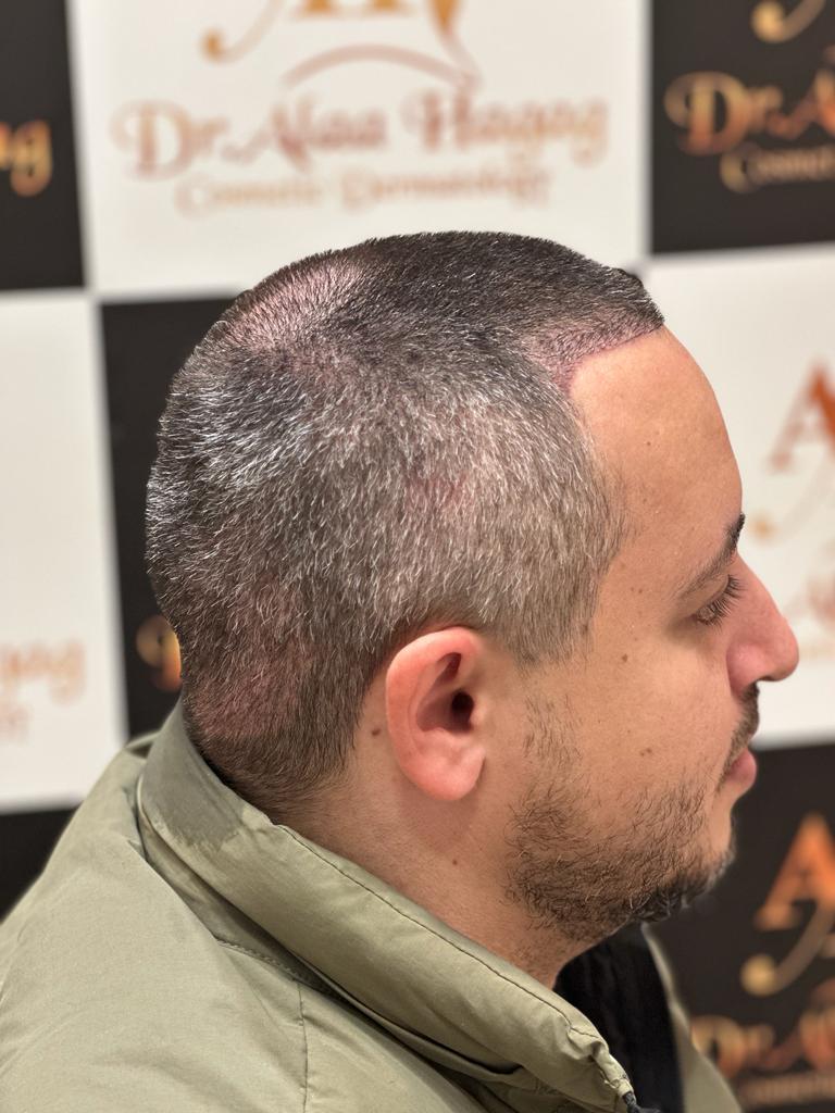 علاج تساقط الشعر