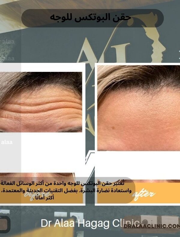 حقن البوتكس للوجه