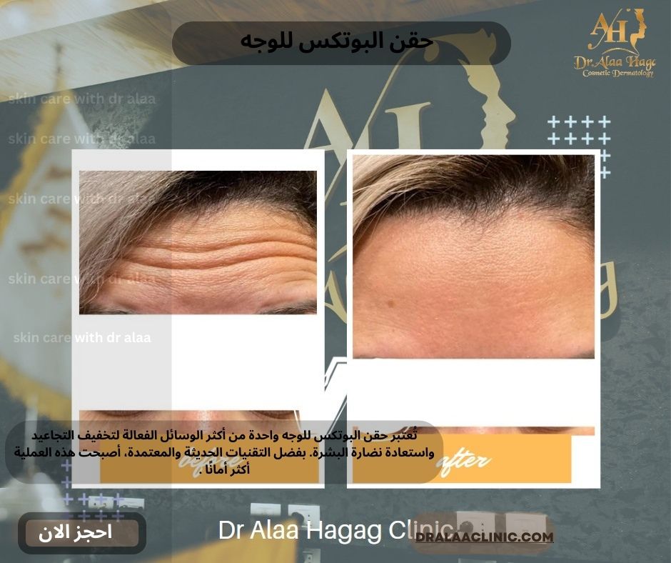 حقن البوتكس للوجه