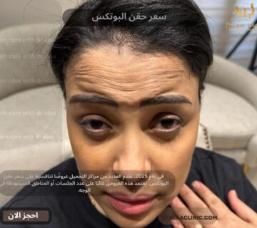 سعر حقن البوتكس