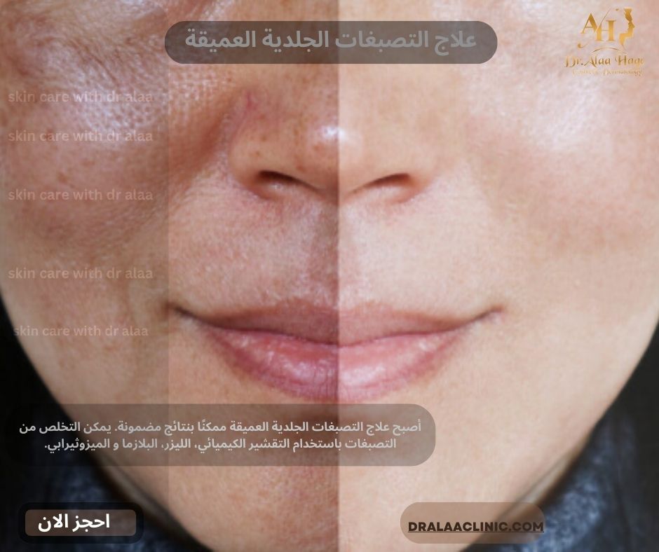 علاج التصبغات الجلدية العميقة