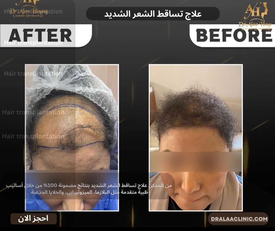 علاج تساقط الشعر الشديد