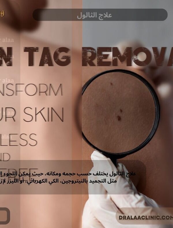 علاج الثالول