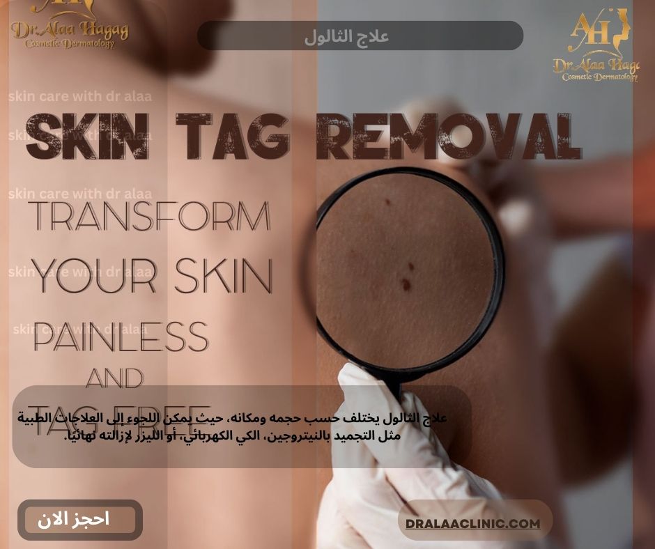 علاج الثالول