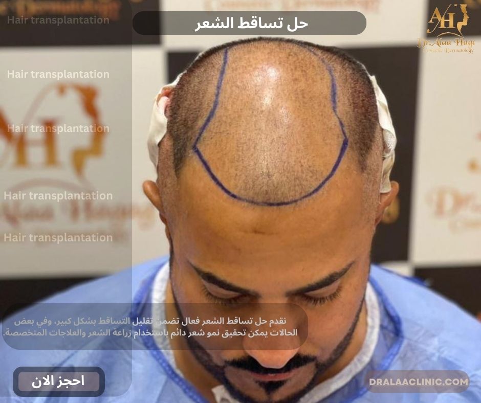 حل تساقط الشعر