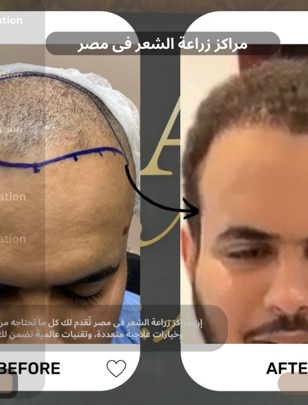 مراكز زراعة الشعر فى مصر