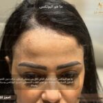 ما هو البوتكس