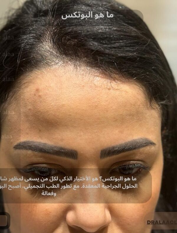 ما هو البوتكس