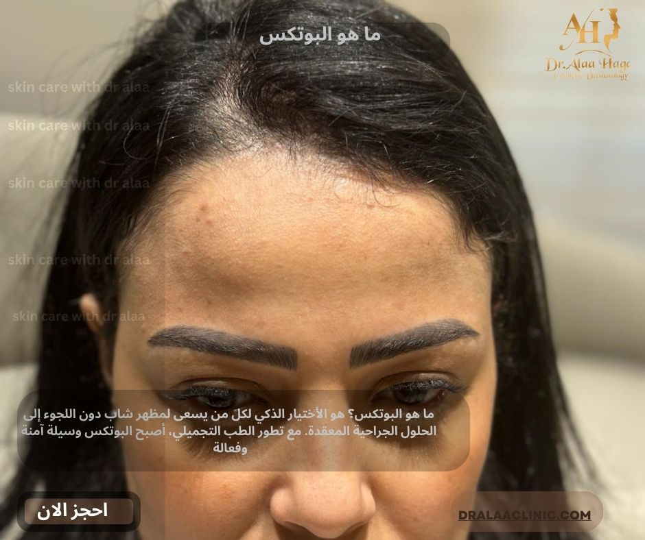 ما هو البوتكس