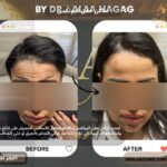 اماكن حقن البوتكس