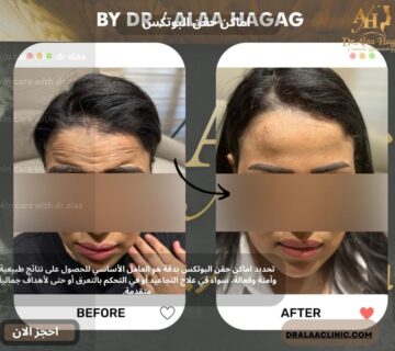 اماكن حقن البوتكس