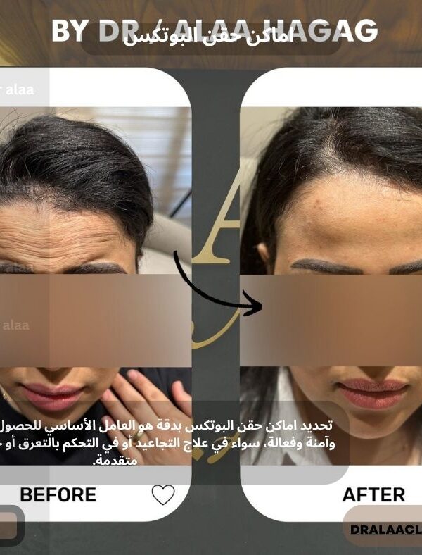 اماكن حقن البوتكس