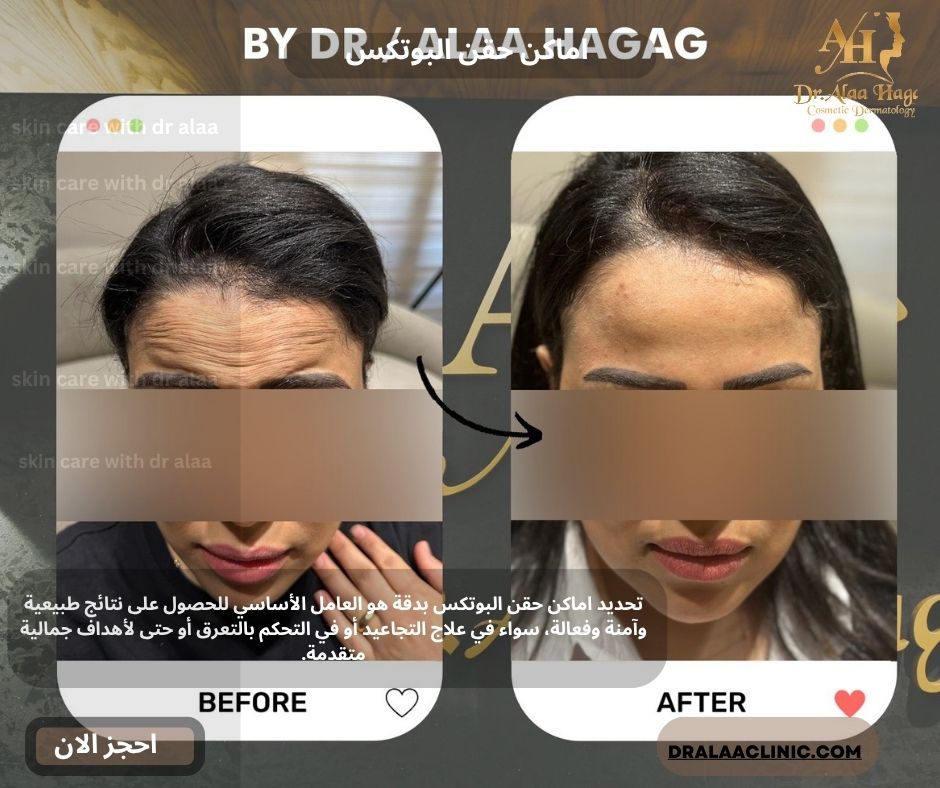 اماكن حقن البوتكس