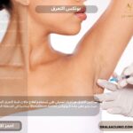 بوتكس التعرق