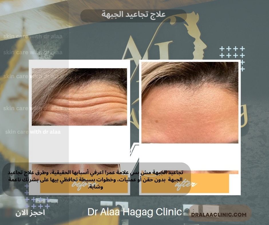 علاج تجاعيد الجبهة