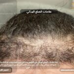 علامات الصلع الوراثي