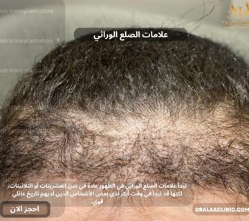 علامات الصلع الوراثي