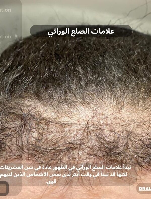 علامات الصلع الوراثي