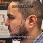 عملية تكثيف الشنب