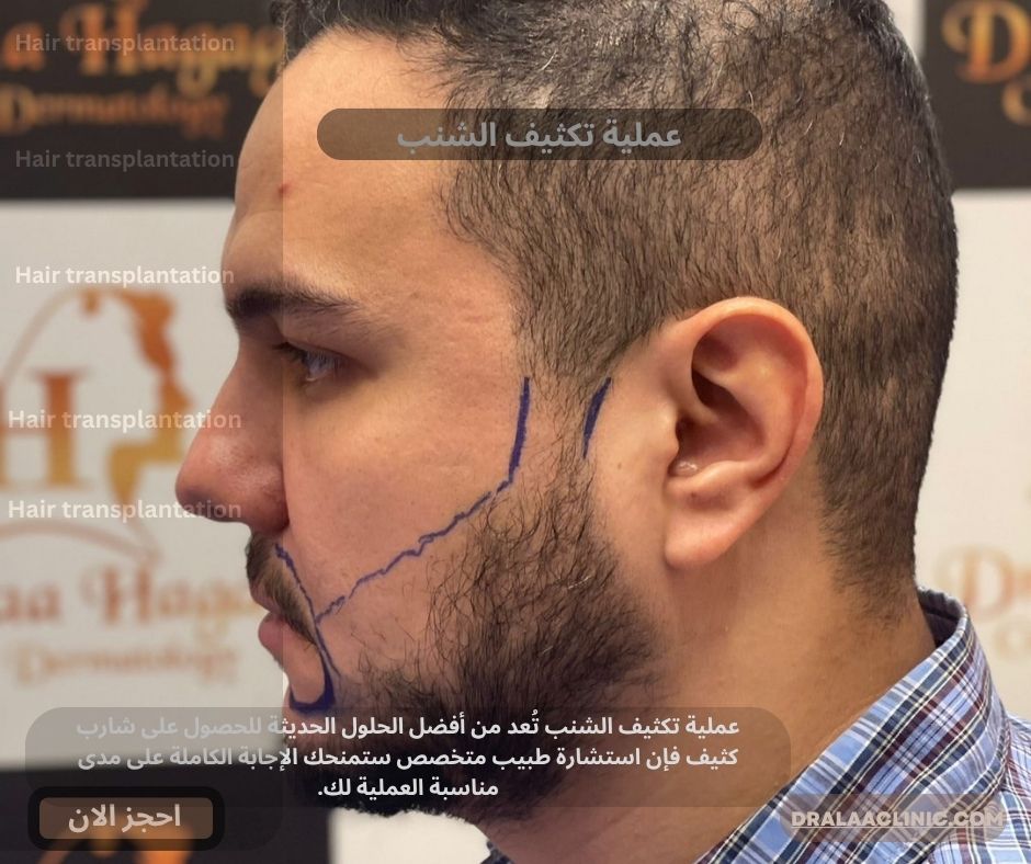 عملية تكثيف الشنب