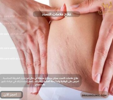علاج علامات التمدد