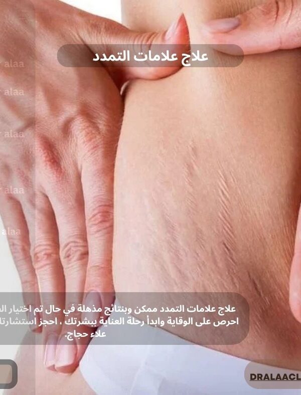 علاج علامات التمدد