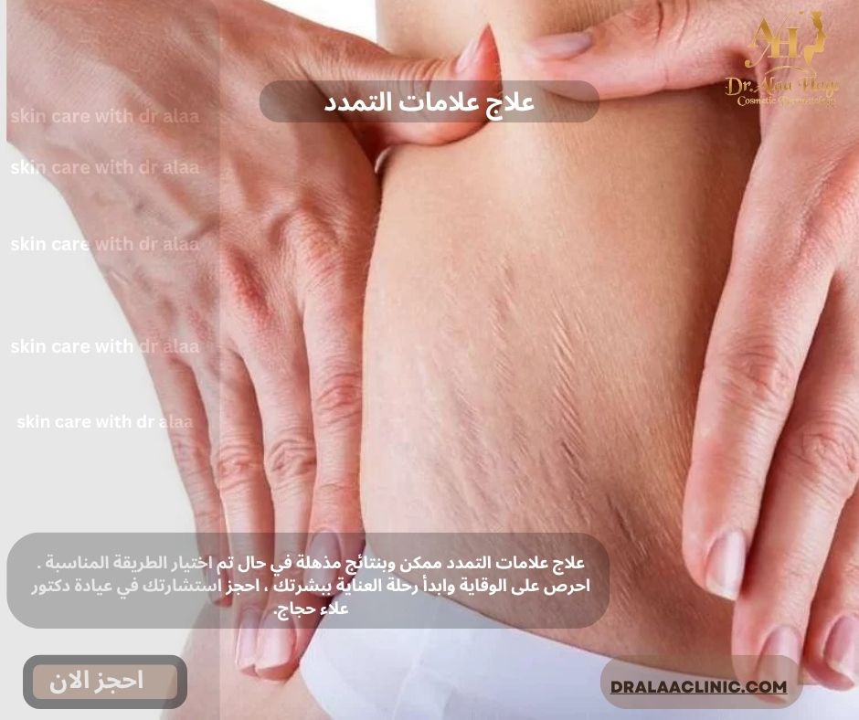 علاج علامات التمدد