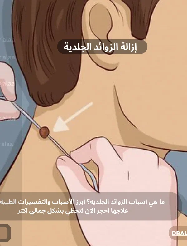 أسباب الزوائد الجلدية