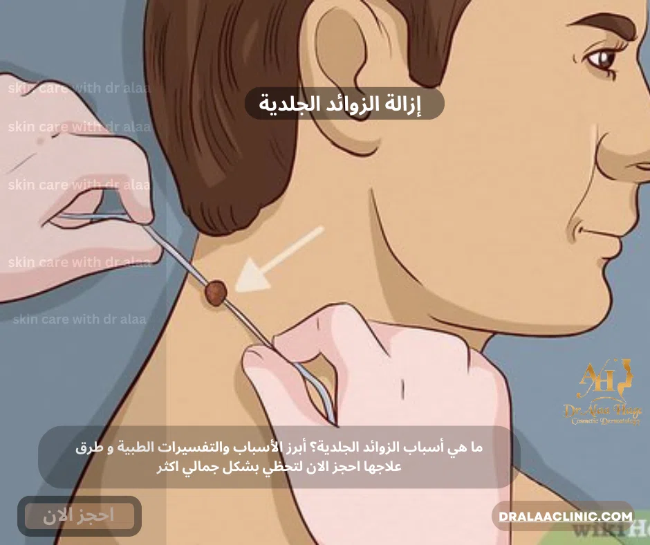 أسباب الزوائد الجلدية