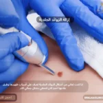 غلاف أشكال الزوائد الجلدية وأسباب ظهورها وطرق علاجها