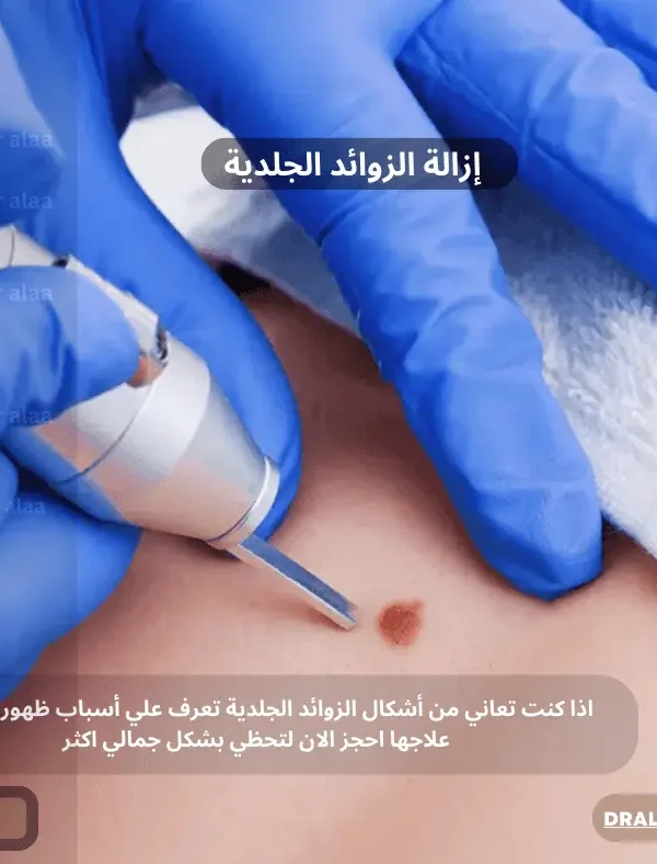 غلاف أشكال الزوائد الجلدية وأسباب ظهورها وطرق علاجها