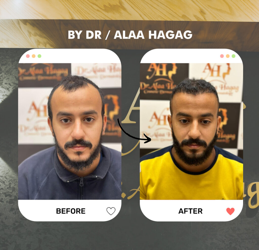 اسباب تساقط الشعر بكثرة