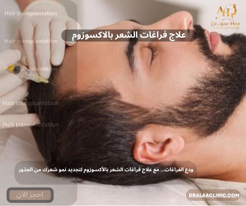 علاج فراغات الشعر بالاكسوزوم