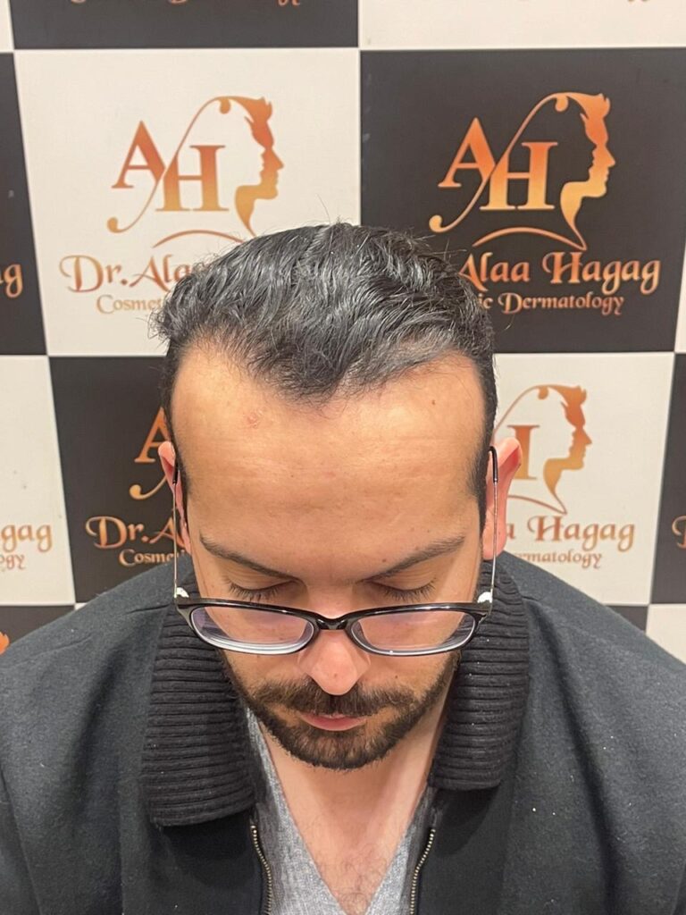 اسباب تساقط الشعر بكثرة